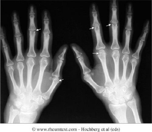 Ουρική αρθρίτιδα  